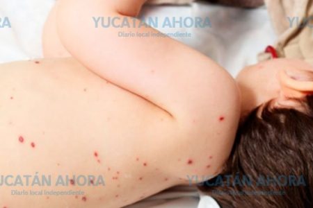 Aparecen 111 nuevos casos de varicela
