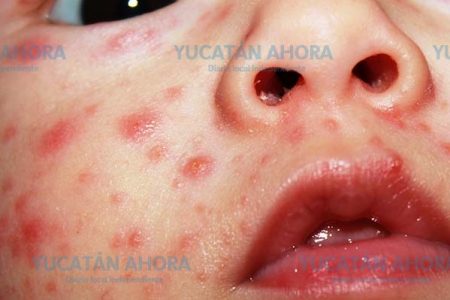 Cada hora se registra un nuevo caso de varicela en Yucatán