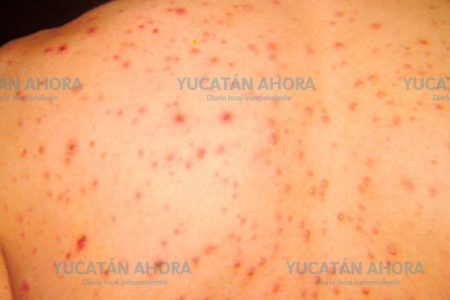 Yucatán tiene su índice más alto de varicela de los últimos cuatro meses