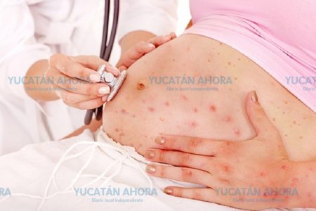 Piden a mujeres embarazadas que se cuiden de la varicela