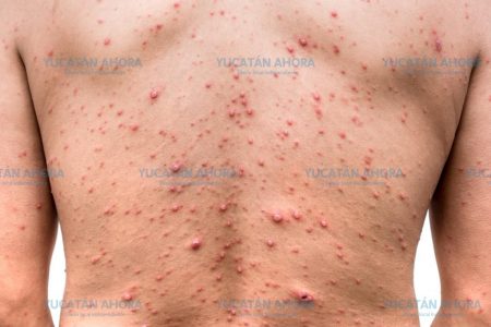 Empieza a ceder la varicela en Yucatán