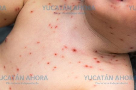 A la baja la incidencia de varicela en la Península