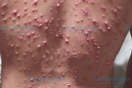 La varicela sigue latente en la Península, diagnostican un caso cada 40 minutos