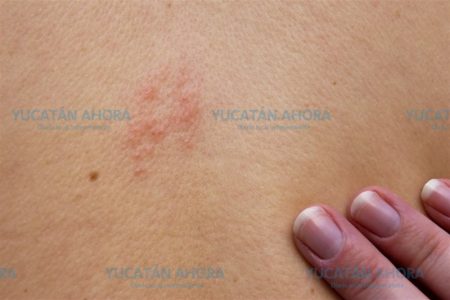 Yucatecos, con alto riesgo de padecer herpes zóster