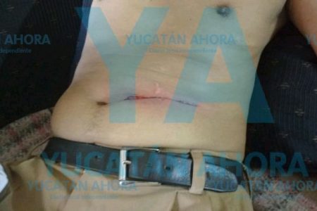 Accidente casero en el sur de Mérida: esméril le rebana la barriga