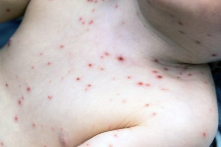 Por primera vez en cinco años se estanca la varicela en Yucatán