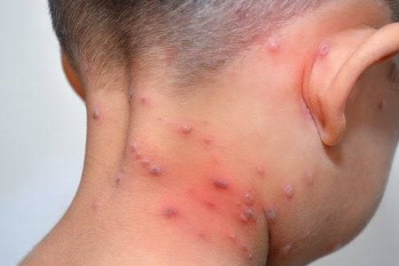 Se duplica la varicela en la Península de Yucatán