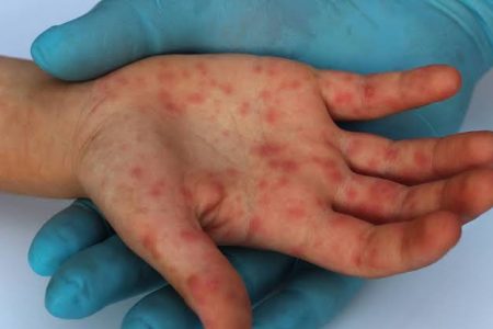 Yucatán se ubica en el quinto lugar nacional en casos de viruela símica